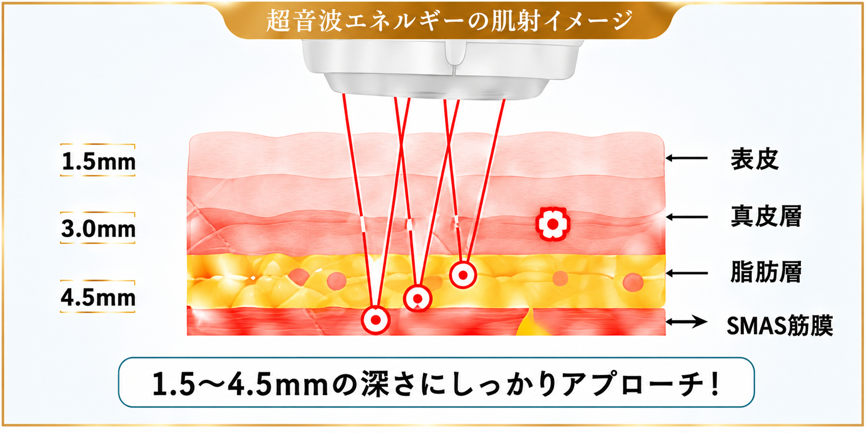 超音波エネルギーの照射イメージ：1.5〜4.5mmの深さ（表皮・真皮層・脂肪層・SMAS筋膜）にアプローチ