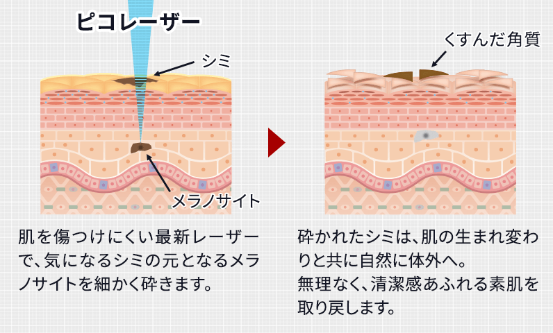 ピコスポット 図解