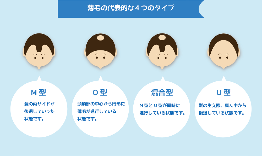 薄毛の代表的な4つのタイプ