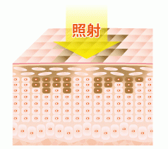 シミ治療のメカニズム1