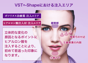 ビスタシェイプ