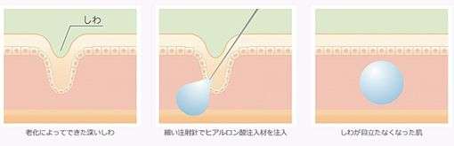 ヒアルロン酸注入とは