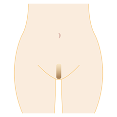 I型