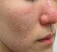 毛穴・肌質改善