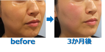 HIFUとフォトIPLの症例写真