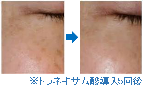 エレクトロポレーション_症例写真