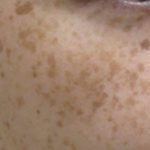 シミ治療モニター1