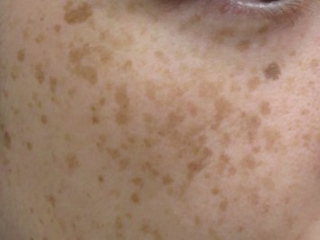 シミ治療モニター1