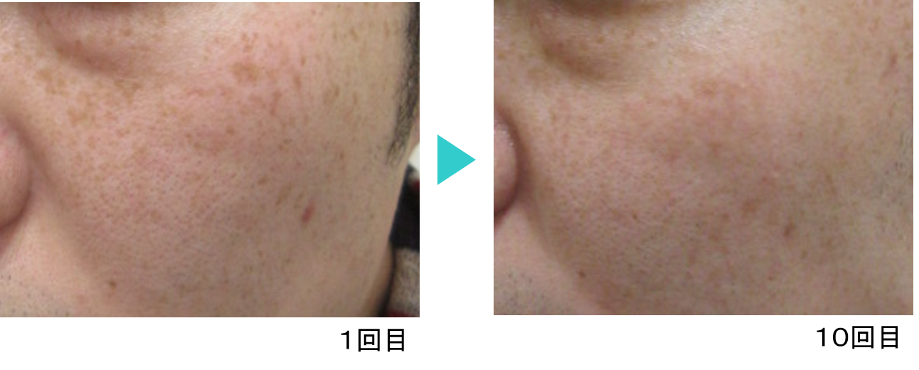 シミ治療モニター11_フォトシルクプラス