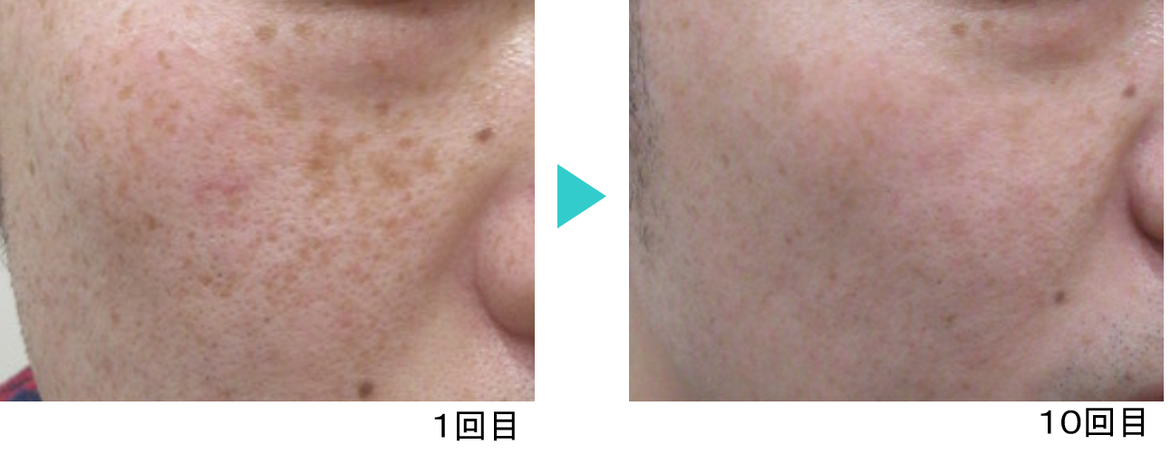 シミ治療モニター12‗フォトシルクプラス