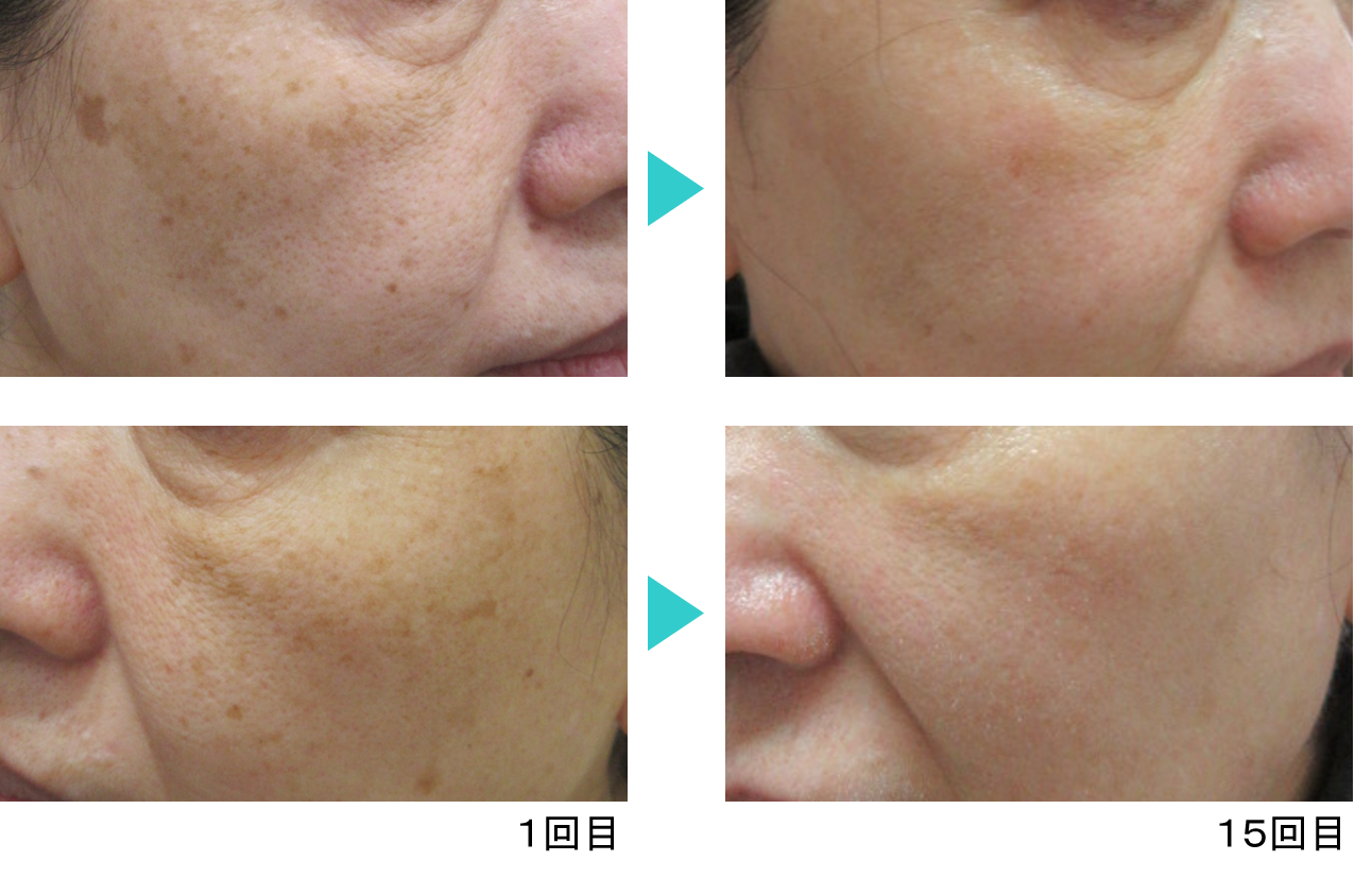 シミ治療モニター3_ヴィーナスヴェルサ