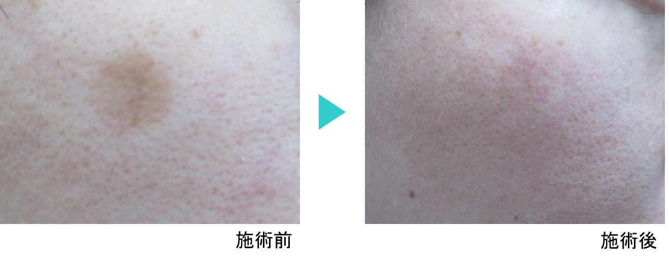 シミ治療モニター7_QスイッチYAGレーザー