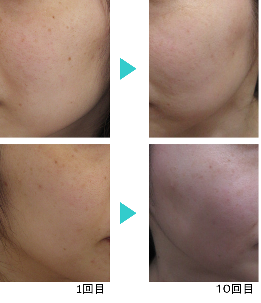 シミ治療 モニター症例 フォトシルクプラス他 公式 銀座 新宿の美容皮膚科エルクリニック