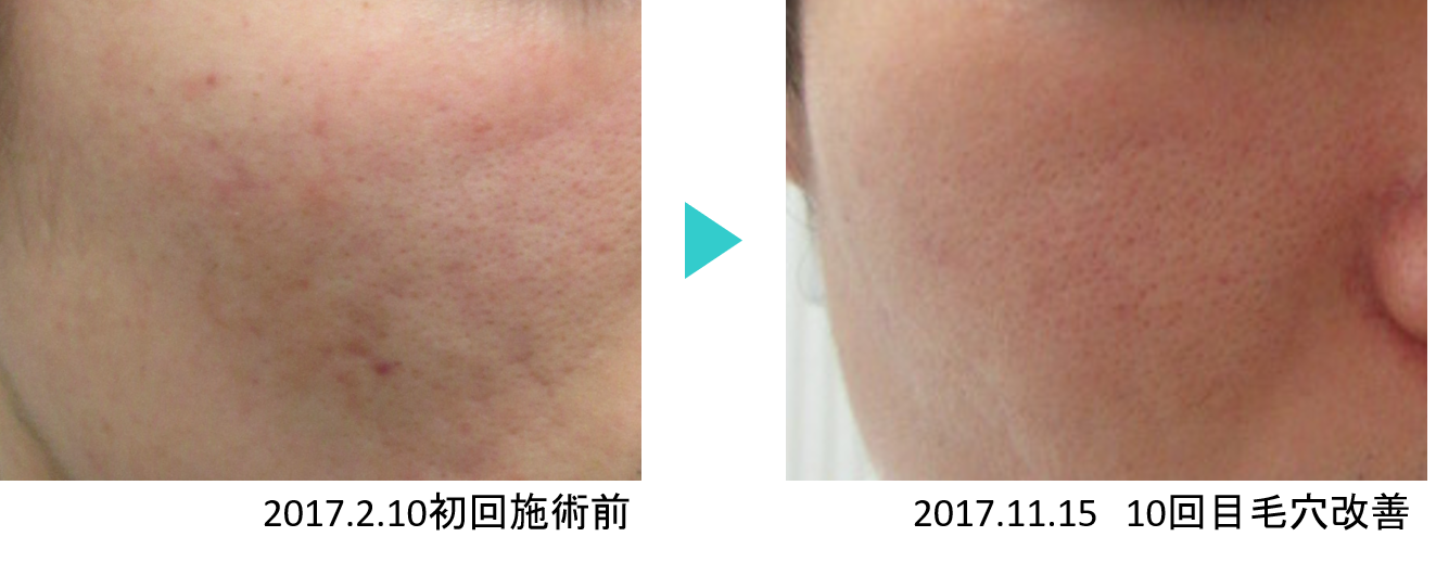 毛穴治療 モニター症例 公式 銀座 新宿の美容皮膚科エルクリニック
