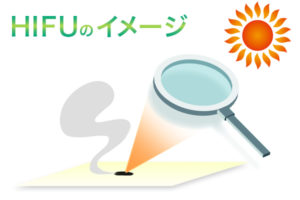 HIFUボディ