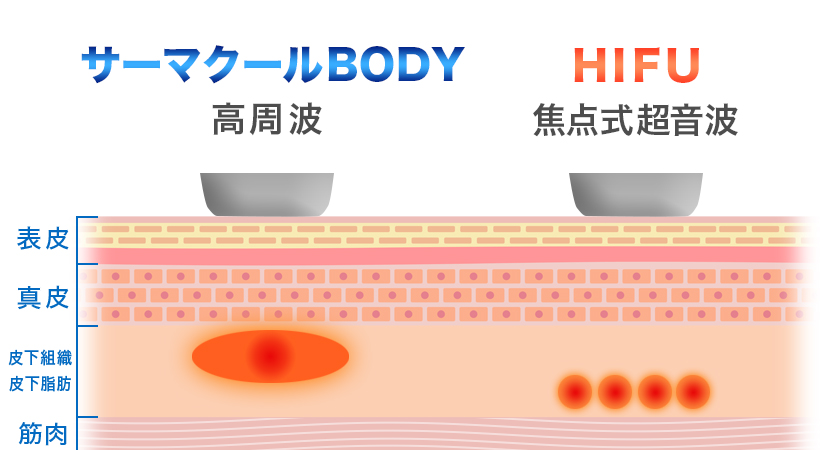 HIFU_サーマクールとの比較
