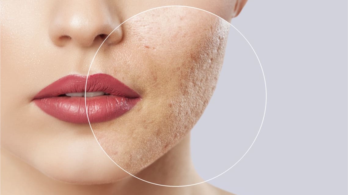 ネオスポリンをニキビに使用した場合の副作用