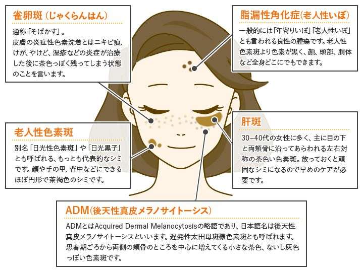 シミの種類