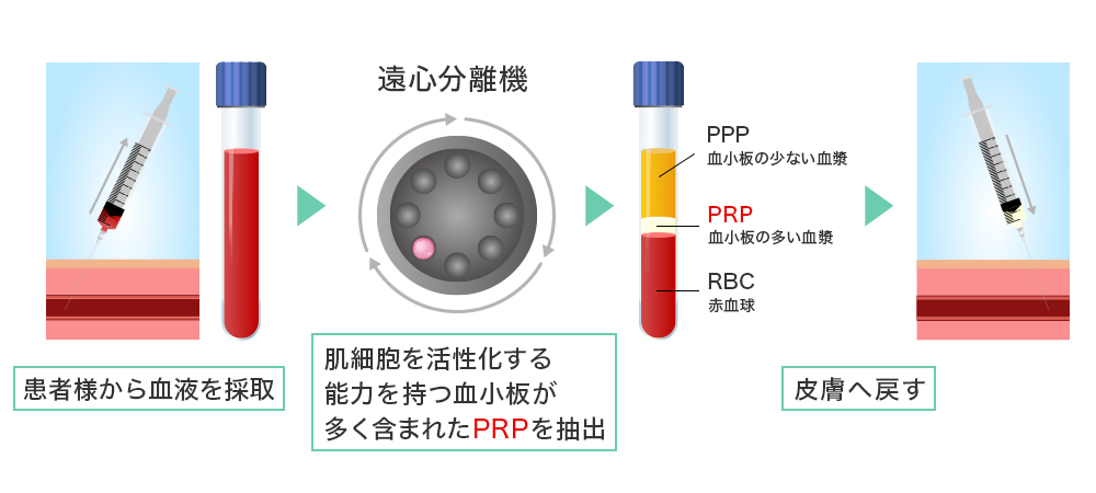 PRP抽出方法