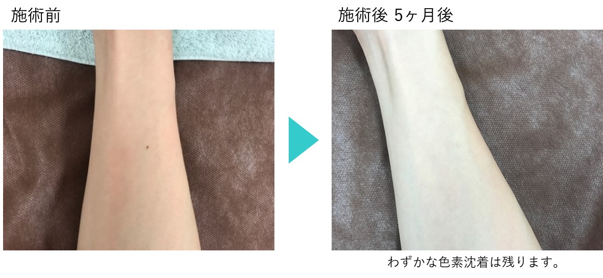 ホクロ除去の症例