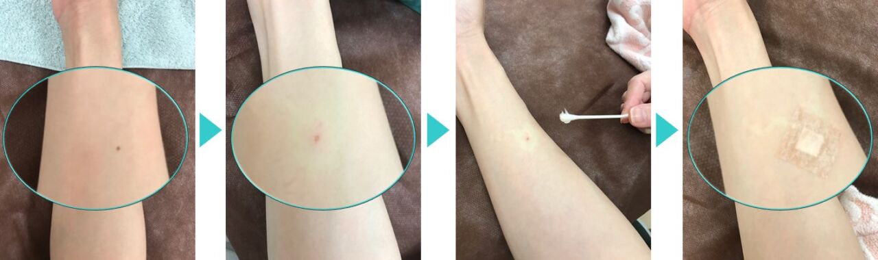 ホクロ処置の経過