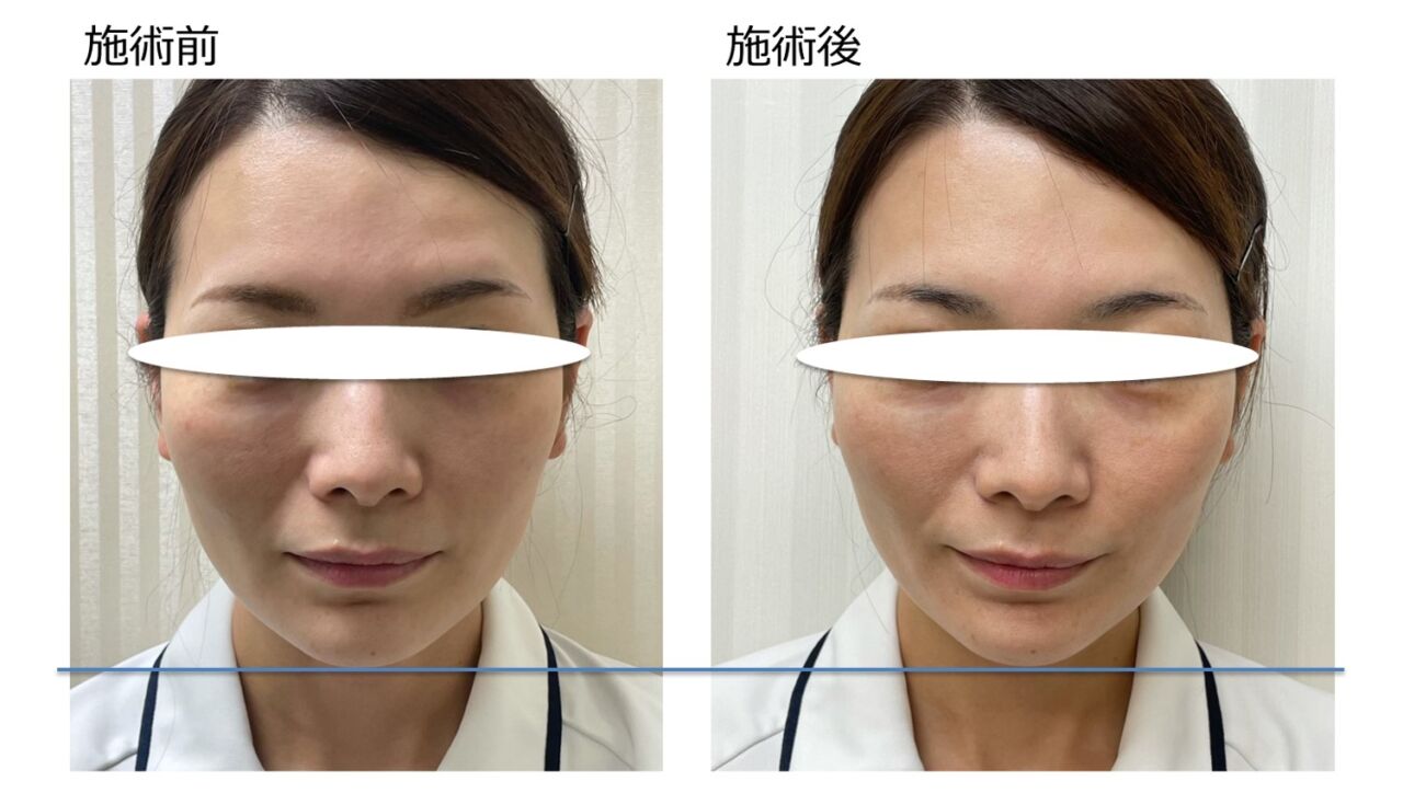 VOVリフトpremium_症例3