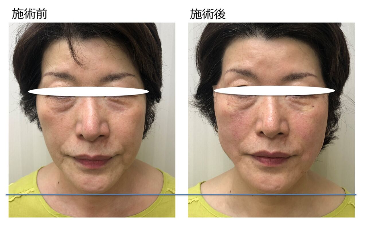 VOVリフトpremium_症例4