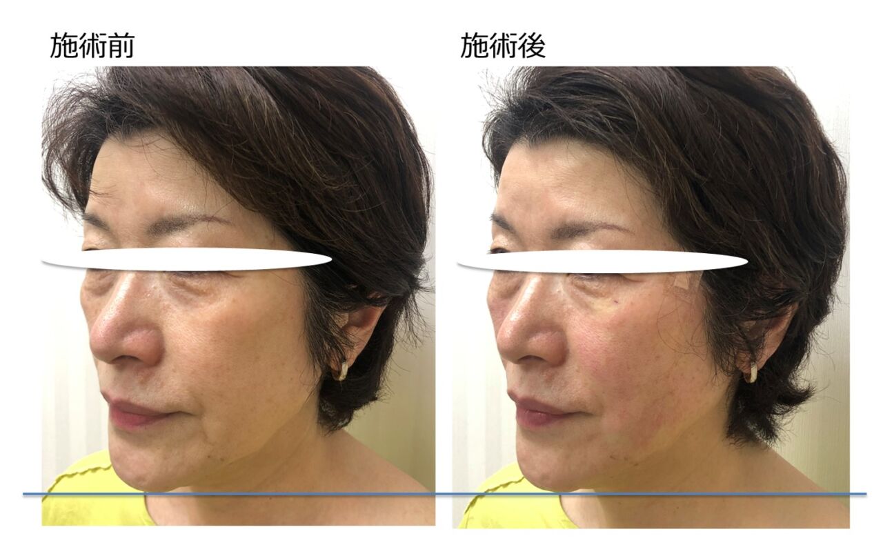 VOVリフトpremium_症例5