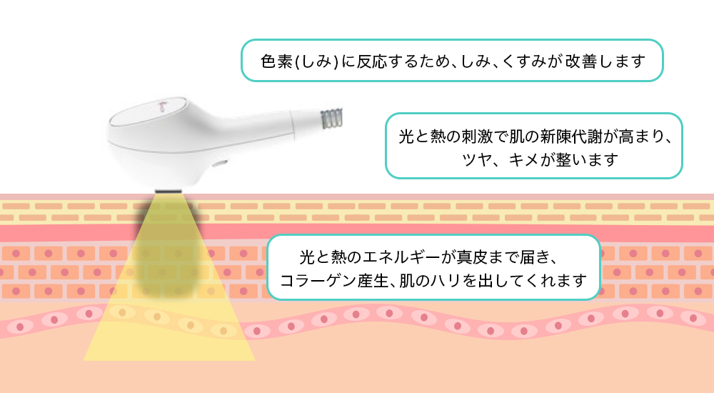 シミ治療 照射後の経過