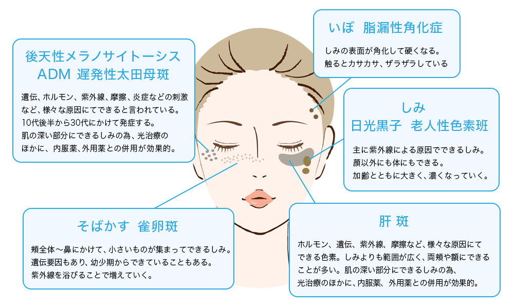 シミのでき方・分類