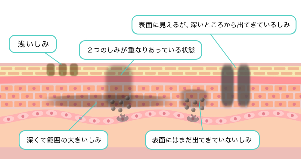 シミの状態について