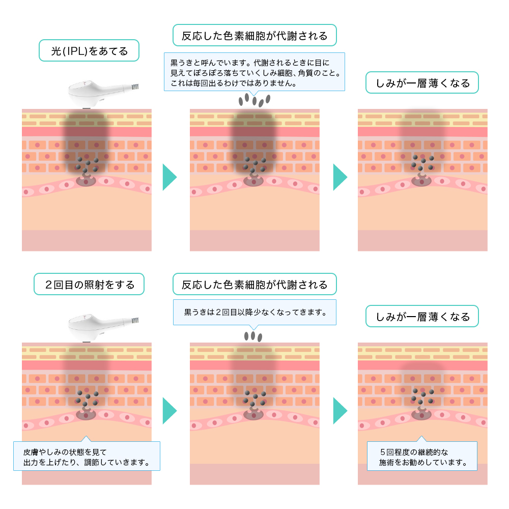 IPL シミ治療 照射後の経過