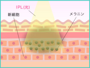 フォトフェイシャル_メカニズム1