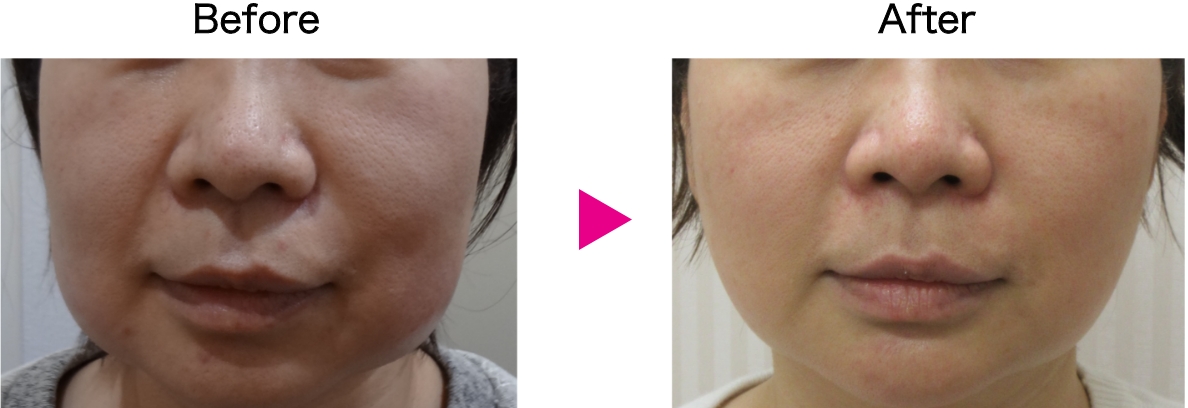 カベリン症例写真