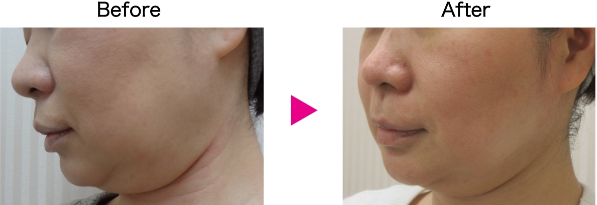 カベリン症例写真