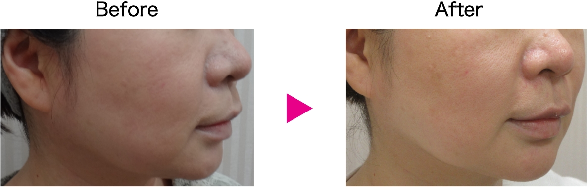 カベリン症例写真