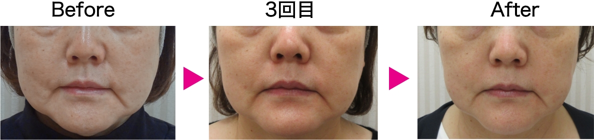 カベリン症例写真