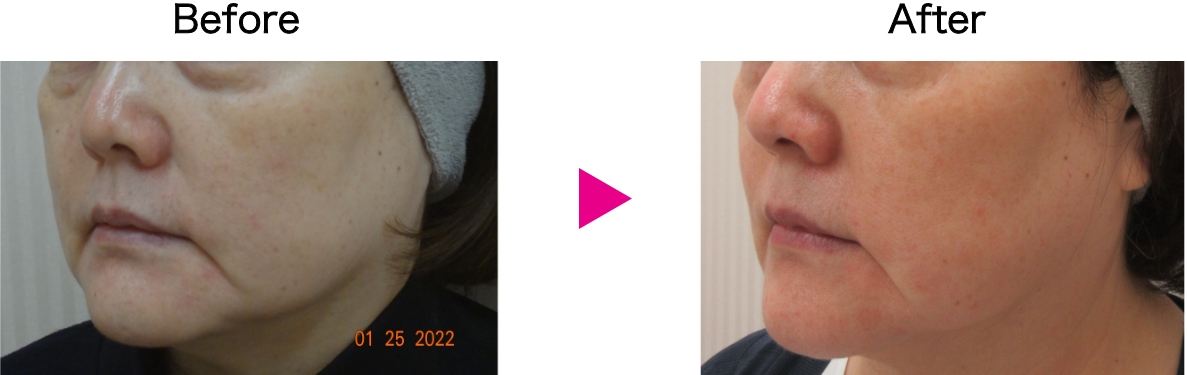 カベリン症例写真