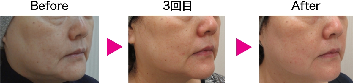 カベリン症例写真