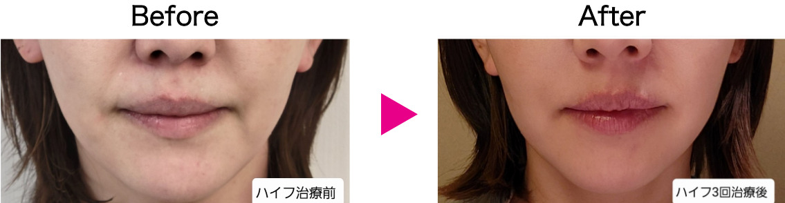 HIFUハイソニックPREMIUM