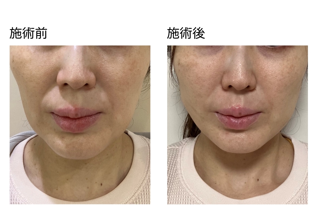 VOVリフトpremium_症例3