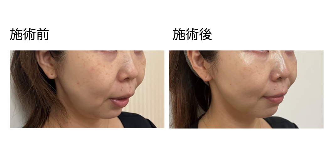 VOVリフトpremium_症例4