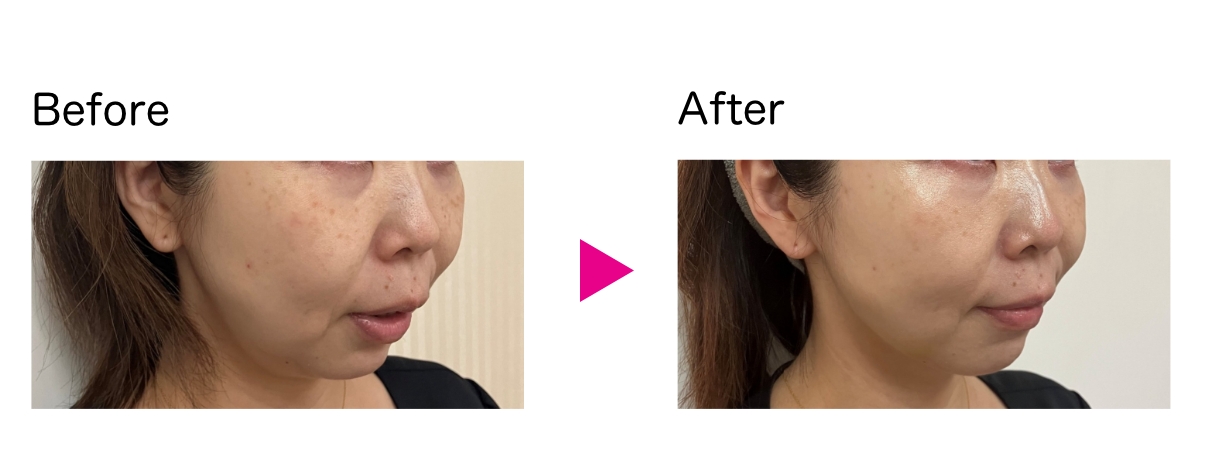 VOVリフトpremium_症例4