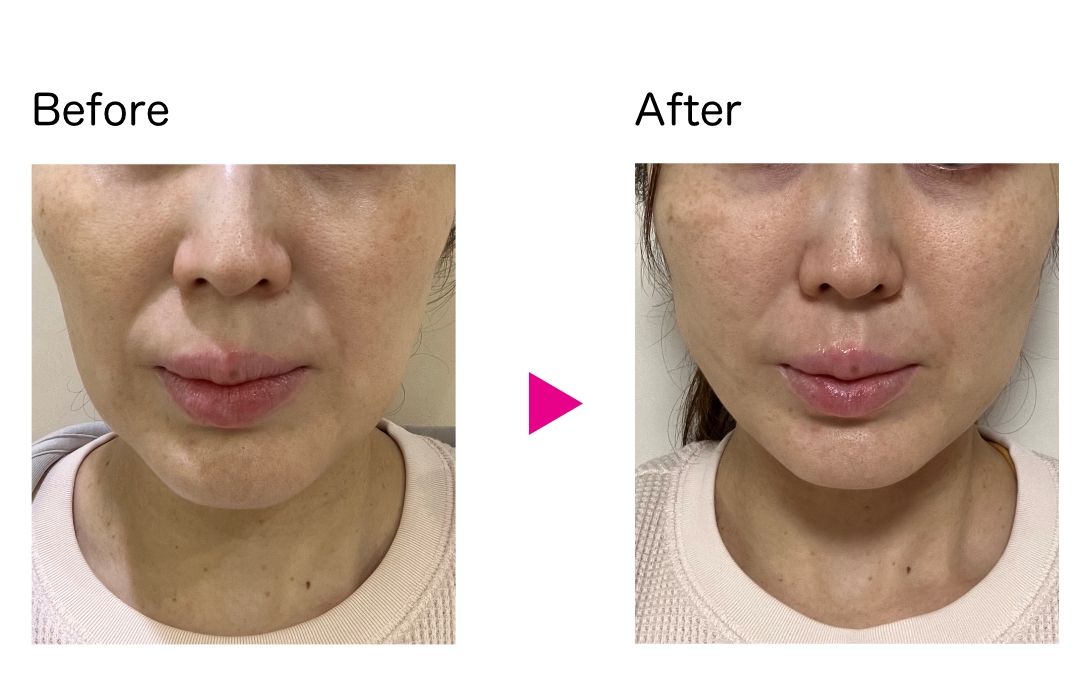 VOVリフトpremium_症例3